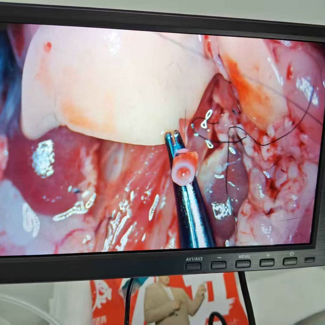 小鼠肝移植模型构建