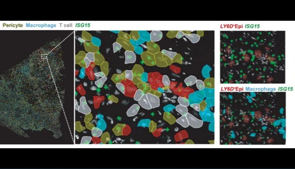 【IF=40.4】单细胞+空间组学破解胆管癌耐药之谜