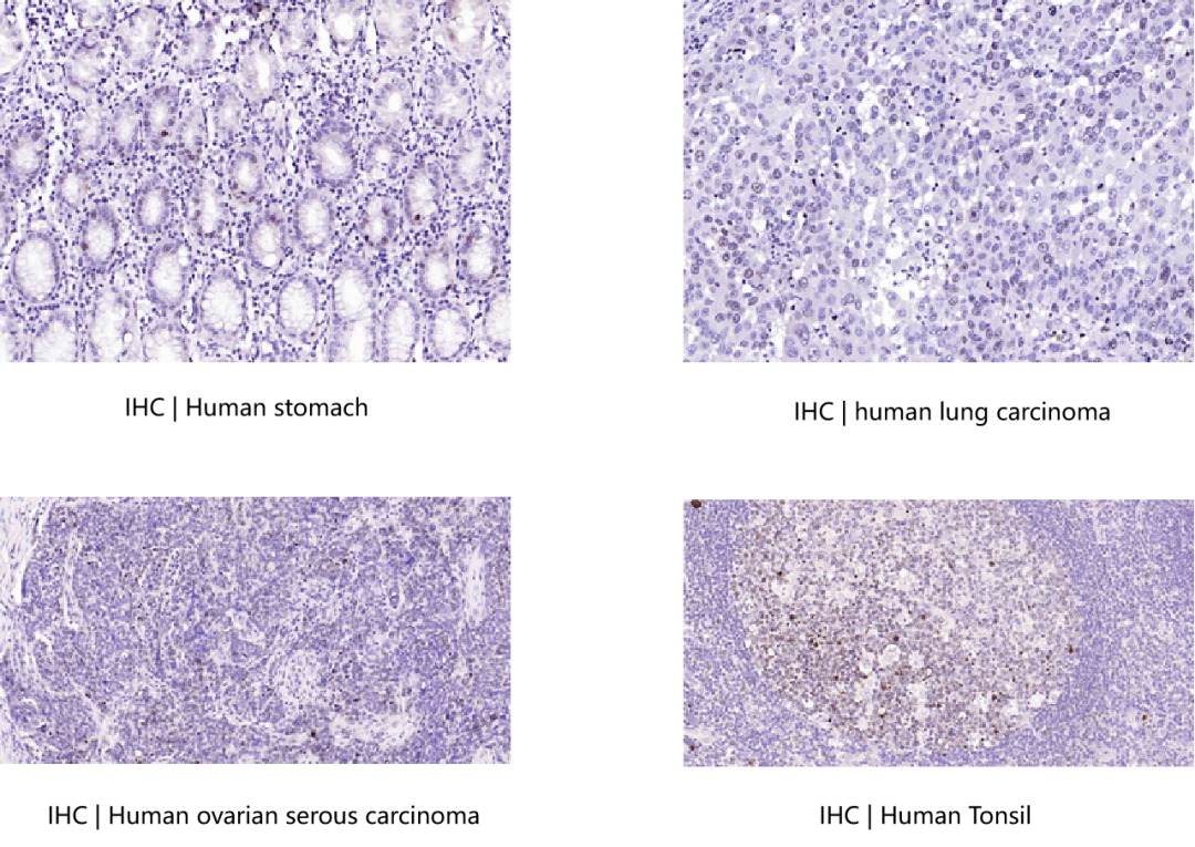 跳出误区：Ki67的价值，远不止“增殖标志物”这么简单