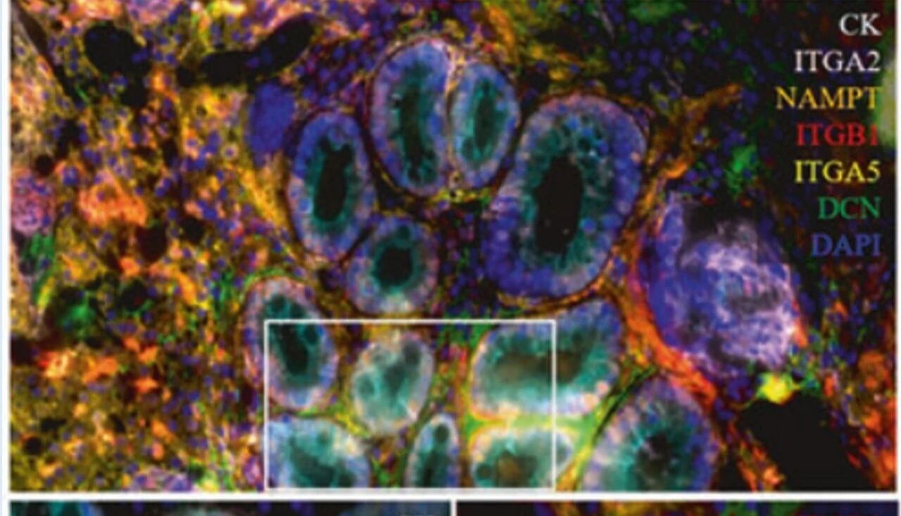 空间多组学|【IF=52.7】胃癌早筛重大突破！