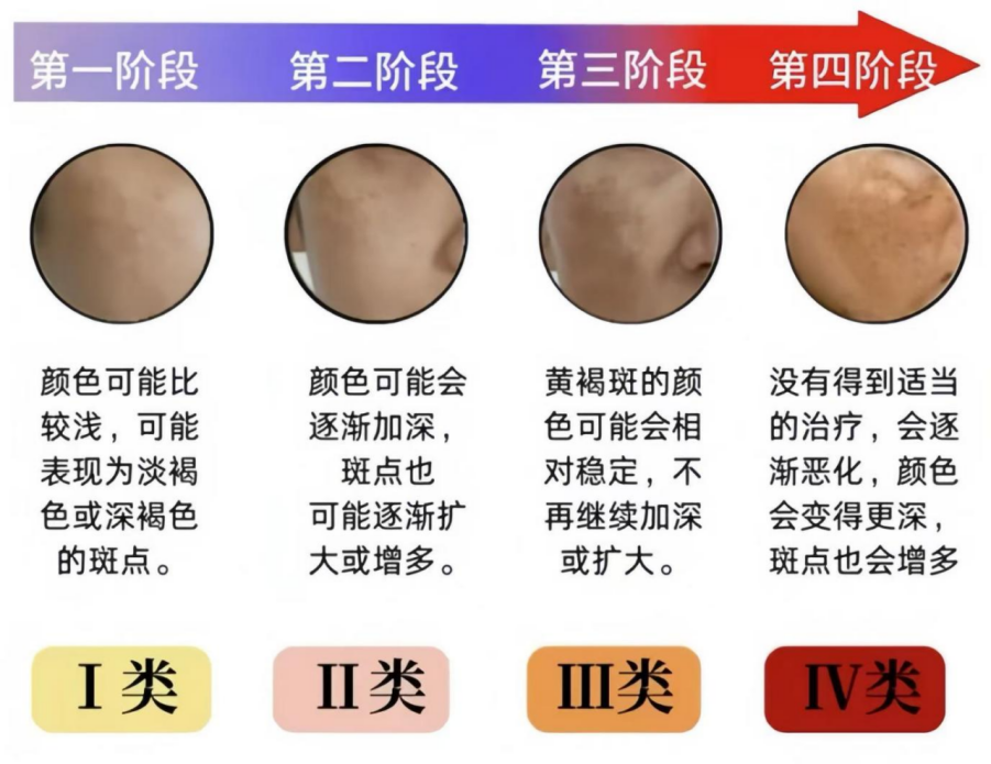 黄褐斑总反复？联合方案稳住皮肤屏障：经皮水分流失值与角质层含水量的检测