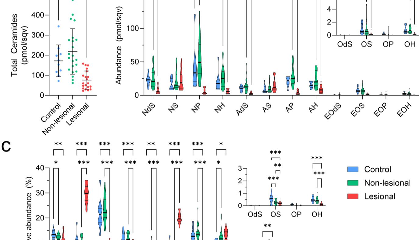 银屑病皮损真相：皮肤角质层神经酰胺图谱全解析