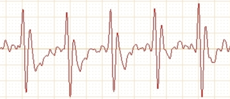 大鼠心肌缺血再灌注模型制备 大鼠心肌缺血再灌注模型制备