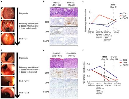 粪便菌群移植可有效治疗免疫检查点抑制剂相关结肠炎