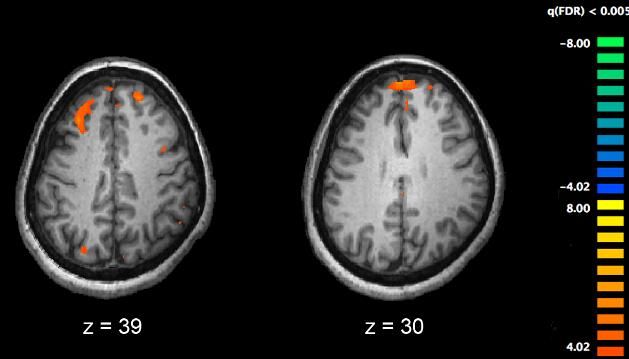 诱发精神分裂症的原因是什么？你知道的以及不知道的都在这里！
