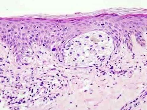 揭示黑色素瘤躲避靶向性疗法杀灭的分子机制