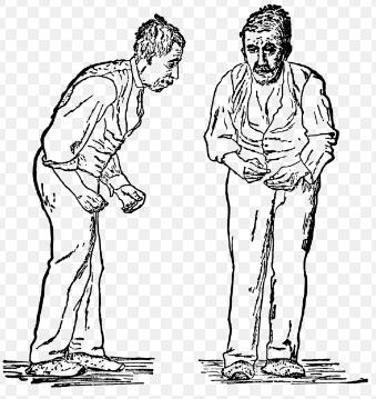 近期帕金森疾病的研究进展