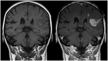 鉴定出32个人基因组位点与中风风险相关
