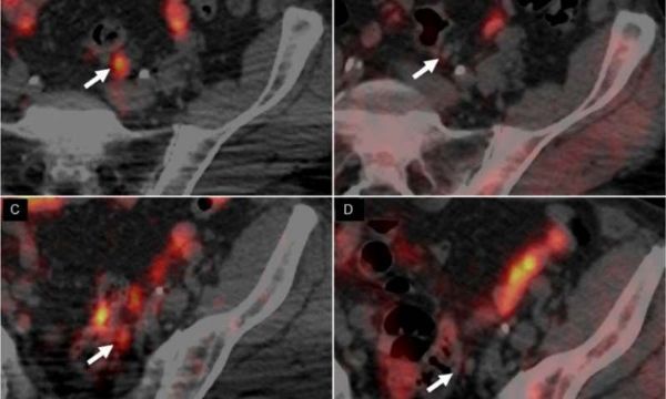 Journal of Nuclear Medicine亮点研究 ：新型PET造影剂更准确检测前列腺癌复发！