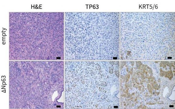 利用胰腺癌的成瘾性来开发新型抗癌疗法