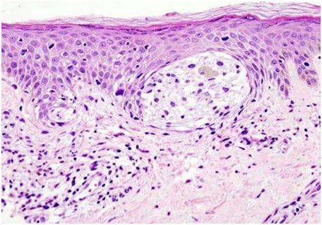 抑制U34-tRNA酶有望治疗对靶向疗法产生抵抗性的恶性黑色素瘤