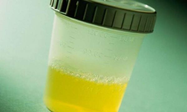 新型无创检测技术有望实现对尿路上皮癌的检测