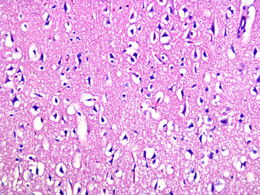 大鼠脑外伤动物模型（TBI）的建立
