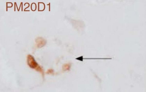 警惕！基因组的特殊突变或会让你更容易患上阿尔兹海默病