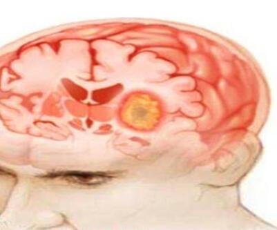 研究发现神经胶质瘤的基因组改变呈现出高度可变的和患者特异性轨迹