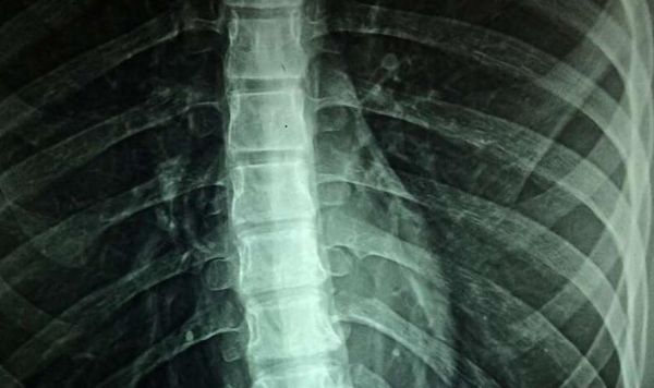 科学家有望利用鼻细胞成功治疗人类脊髓损伤