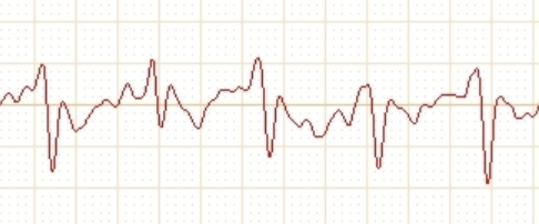 大鼠心肌缺血再灌注模型制备 大鼠心肌缺血再灌注模型制备