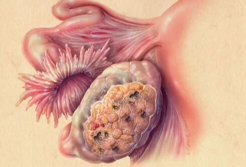 淋巴管内皮细胞或能有效促进黑色素瘤扩散
