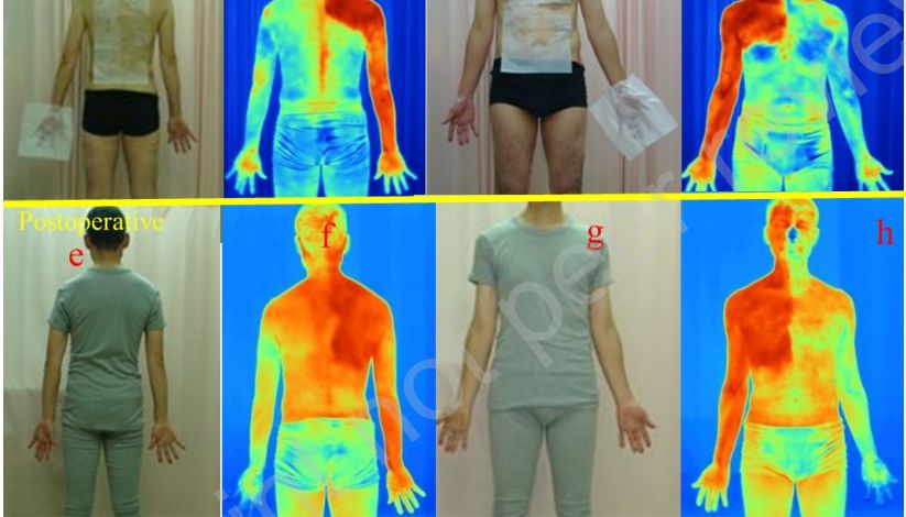 代偿性出汗复发：OZ-2激光散斑血流成像（LSFG）确定神经节位置