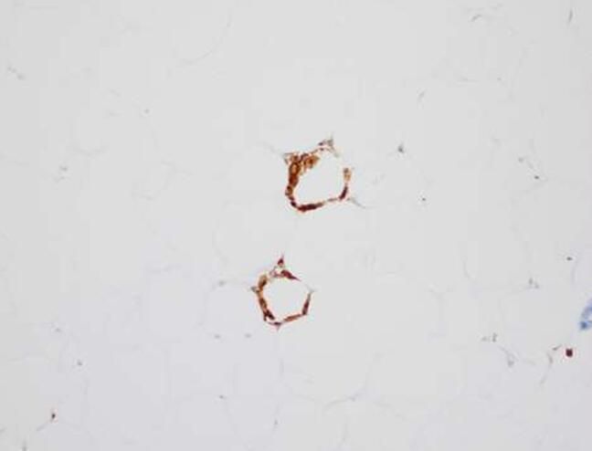 【前沿资讯】Cancer Prev Res：不可思议！健康体重指数的女性居然更易患乳腺癌！