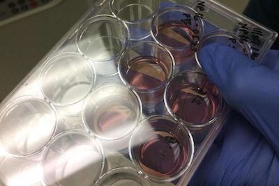 干细胞研究揭示阿兹海默症新疗法