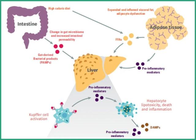非酒精性脂肪肝炎（NASH）检测点，看这里就行！