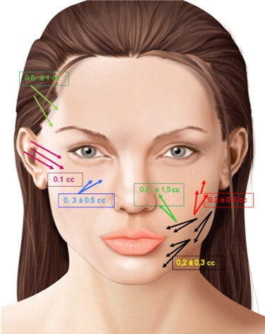 左旋聚乳酸PLLA(药用级）安全性可靠吗？