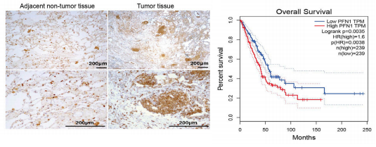 蛋白组学资讯:百趣协助,非小细胞癌转移机制新解