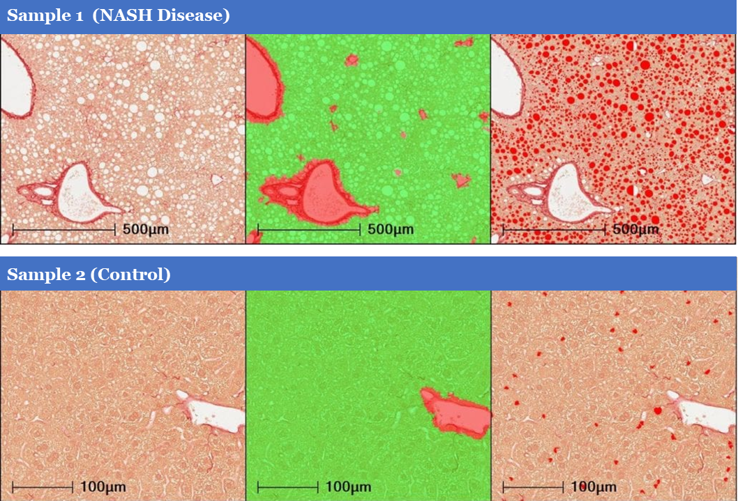 HALO在NAFLD/NASH小鼠模型组织病理学的定量评估