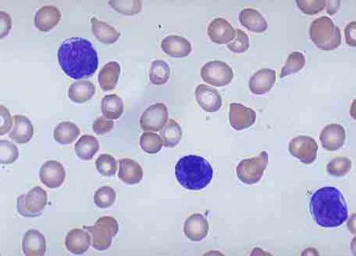 慢性淋巴细胞性白血病细胞存活的机制