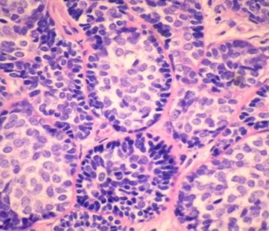 白细胞介素34与三阴性乳腺癌之间存在联系