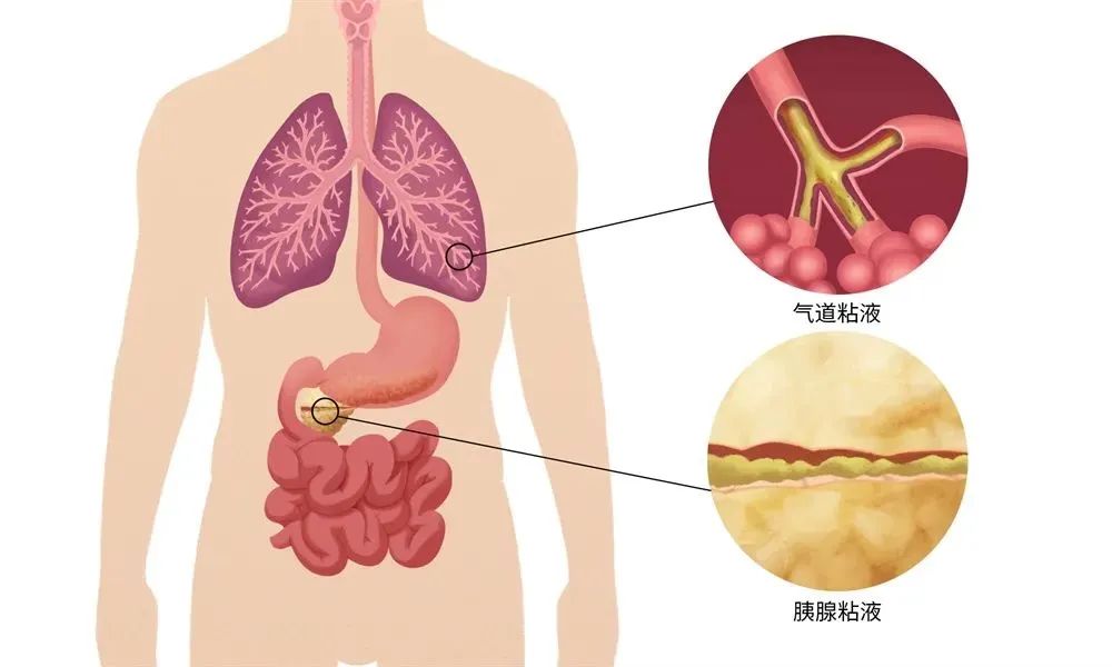 “薯片味的孩子”——被北欧诅咒缠身的新生儿