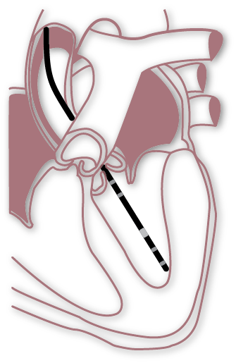 左心室放置压力容积导管–颈动脉 vs 心尖入路