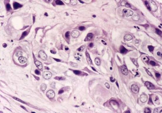 UNX2在更具侵略性的人类肿瘤中升高