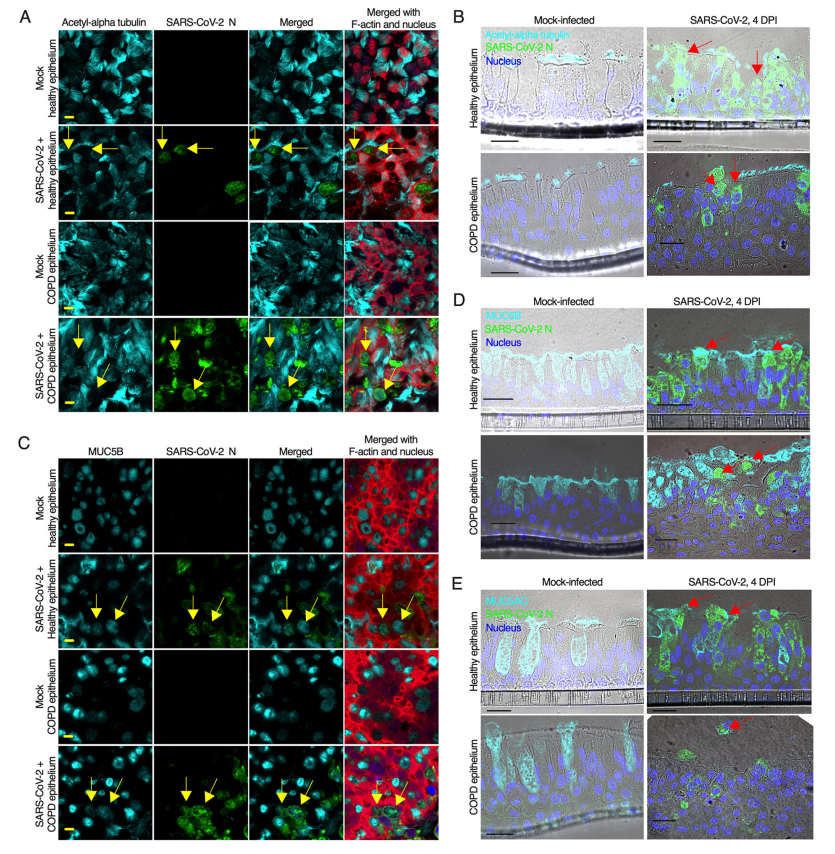 支气管杯状细胞中的MUC5B和MUC5AC蛋白在新型冠状病毒中的研究