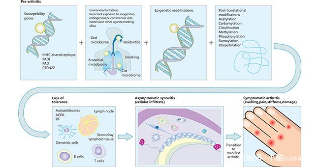 细胞因子和类风湿性关节炎