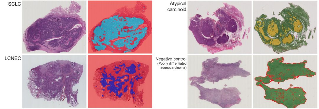 HALO AI识别肺神经内分泌肿瘤的组织学亚型