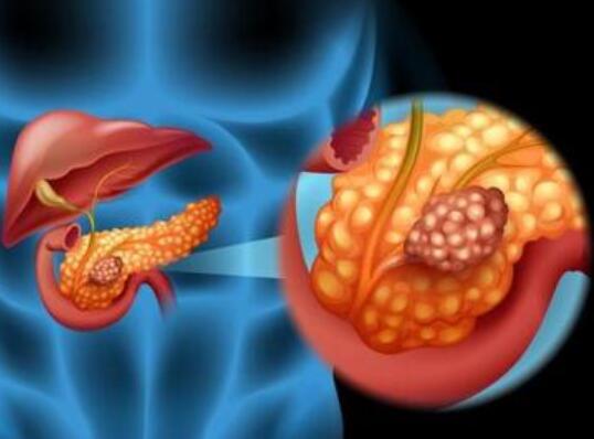 神经组织或能保持胰腺癌细胞免于饥饿