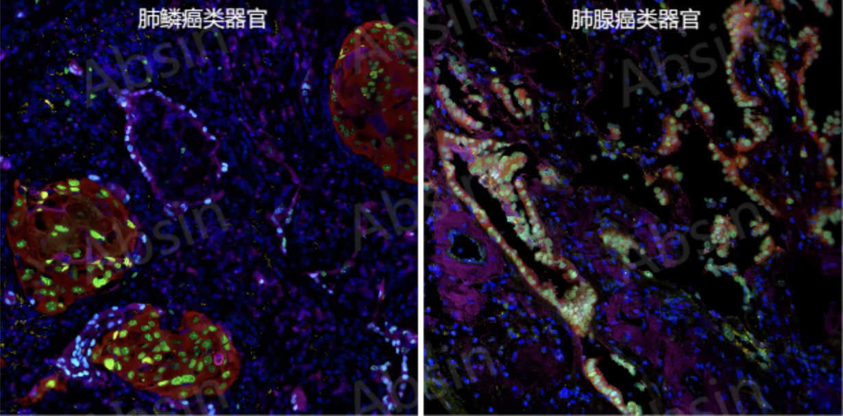 多色类器官宝典：肺癌类器官的培养与多色鉴定