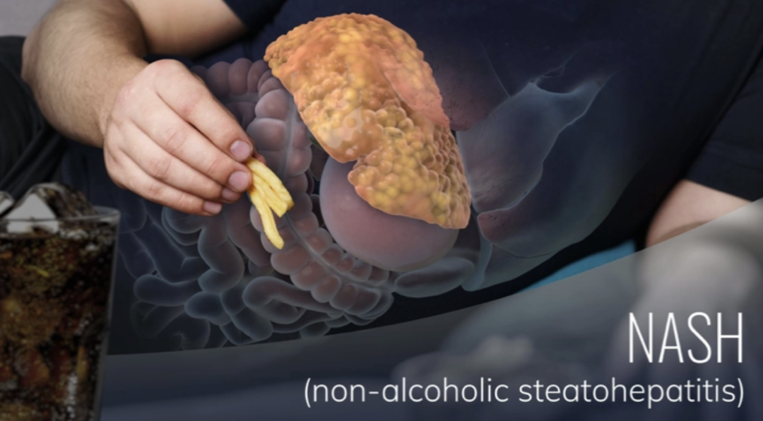 肝病: FGF19靶点 - 非酒精性脂肪肝炎NASH临床2b