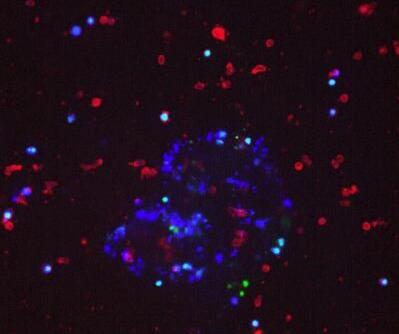 乳腺癌细胞避开免疫系统转移或传播到身体其他部位的新机制