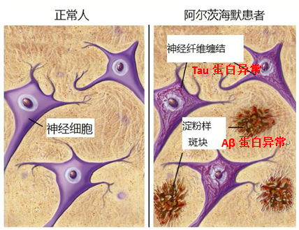 常见生物标志物之神经退行性疾病——Aβ、α-synuclein、Tau
