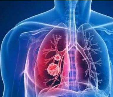 NK细胞抵抗肺癌的分子机制