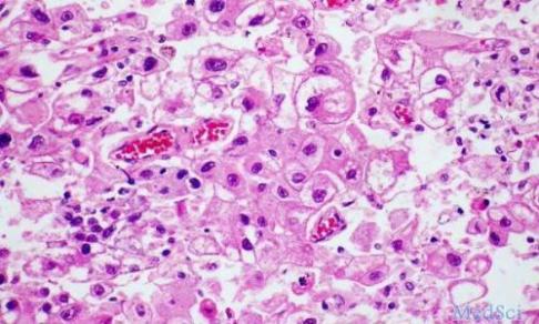 单细胞 RNAseq 分析确定与肝细胞癌相关的T细胞的过渡状态