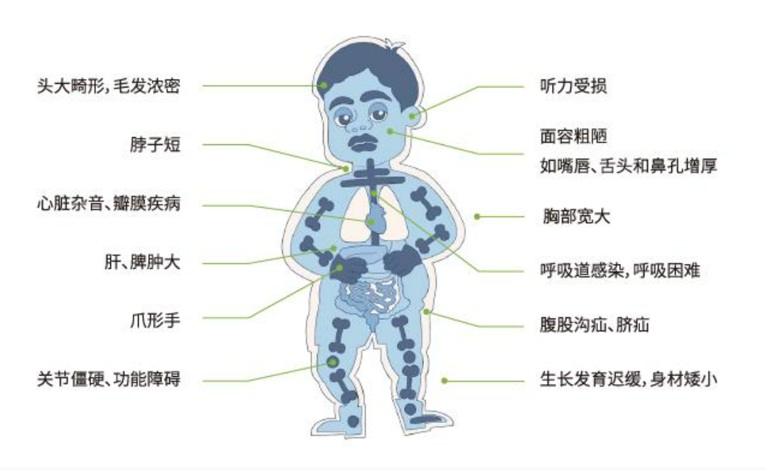 黏多糖贮积症可治！期待粘宝宝们“破茧重生”【罕见病并不罕见】