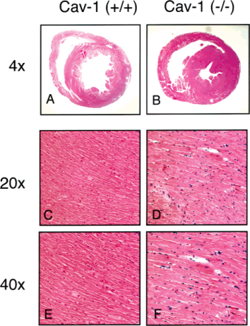先天性全身性脂肪萎缩症
