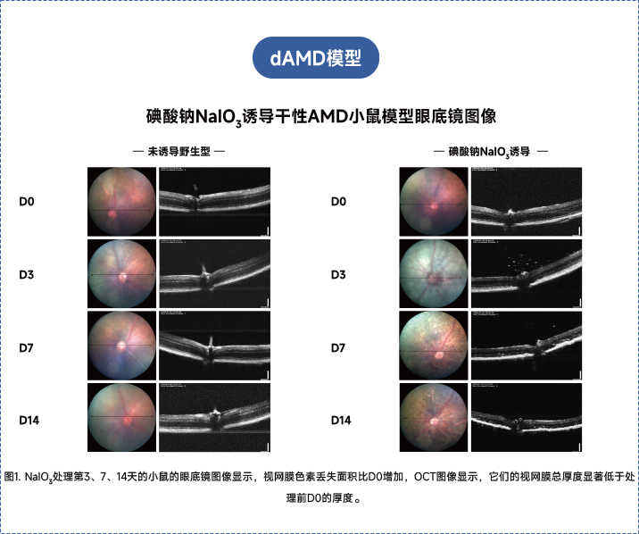 年龄相关性黄斑变性