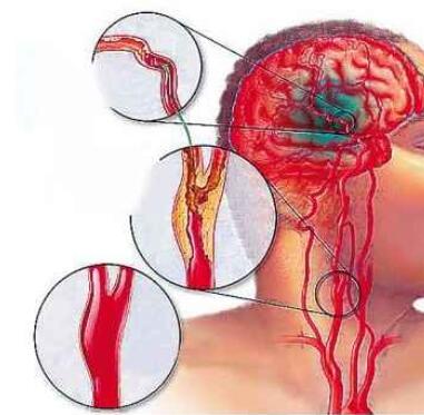 干细胞移植改善脑梗死预后及其后遗症