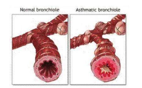研究发现人类气道中的平滑肌细胞触发哮喘机制