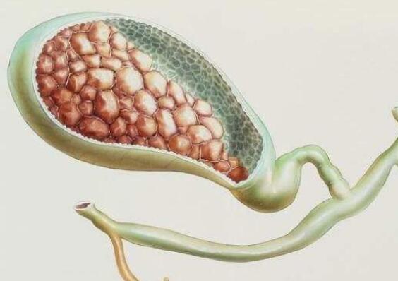 胆结石疾病与患者胃肠道癌症之间的关联